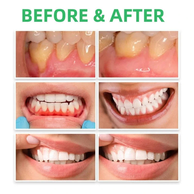 Gum Repair : Relief & Tartar Removal