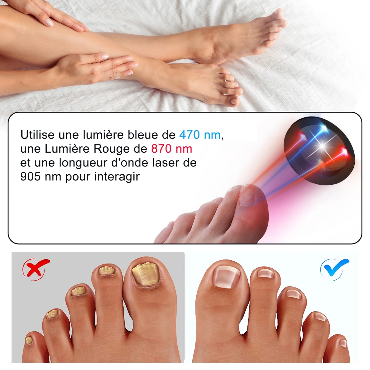 Appareil laser contre les champignons des ongles :