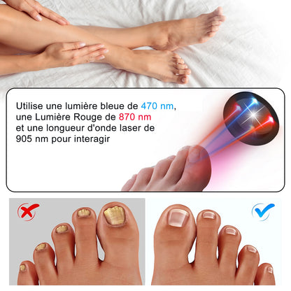 Appareil laser contre les champignons des ongles :