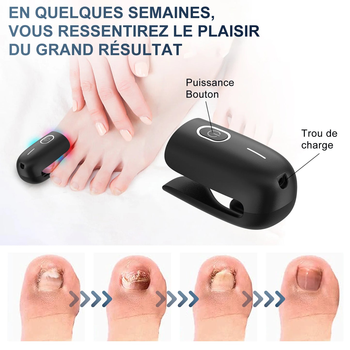 Appareil laser contre les champignons des ongles :